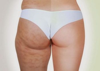 Cum poti combate celulita