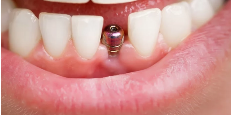 Pentru cine sunt recomandate implanturile dentare si care sunt contraindicatiile