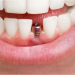 Pentru cine sunt recomandate implanturile dentare si care sunt contraindicatiile