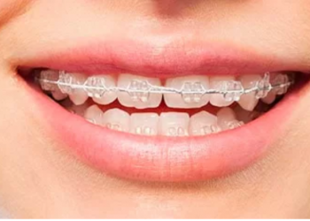 Cat costă un aparat dentar? Factorii care influenteaza, in mod real, pretul