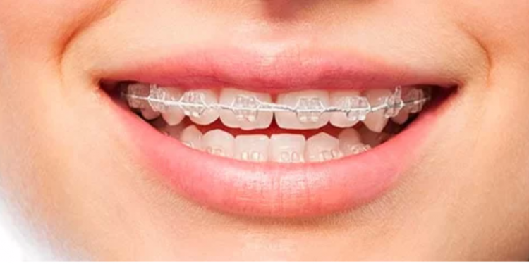 Cat costă un aparat dentar? Factorii care influenteaza, in mod real, pretul